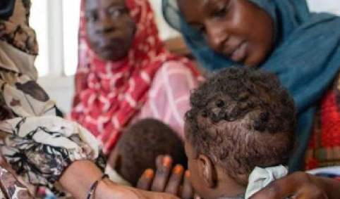 تحليلات مستقلة تتوقع اصابة 179 ألف طفل بسوء التغذية الحادة بين 2025 و 2026